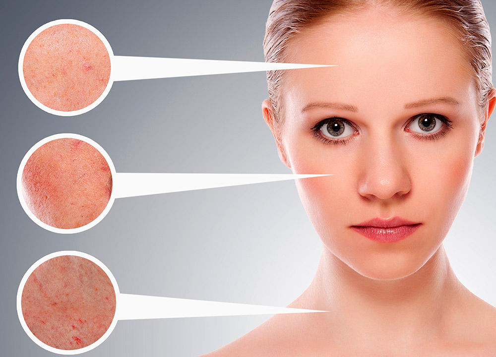 การรักษา rosacea ที่บ้าน