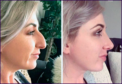 2 signs you might need rhinoplasty